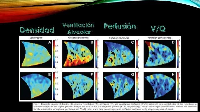 Pronacion en sira Ventilación y Perfusión Pulmonar en posturas Prono y Supino