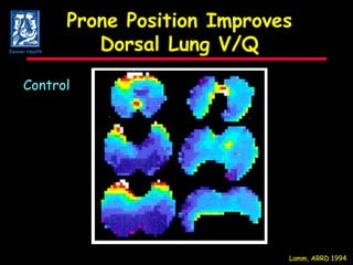 Prone Position Improves Dorsal Lung V/Q Lamm, ARRD 1994 Control Denver Health 