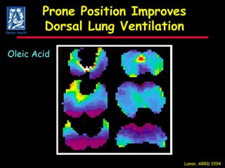 Prone Position Improves Dorsal Lung Ventilation Lamm, ARRD 1994 Oleic Acid Denver Health 