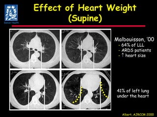 Effect of Heart Weight (Supine) Albert, AJRCCM 2000 41% of left lung under the heart Malbouisson, ’00 -  64% of LLL -  ARDS patients -     heart size Denver Health 