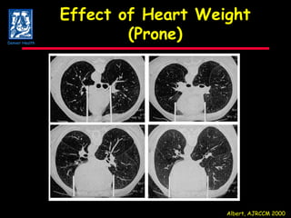Effect of Heart Weight (Prone) Albert, AJRCCM 2000 Denver Health 
