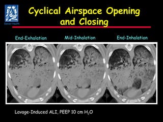 Cyclical Airspace Opening and Closing End-Exhalation Mid-Inhalation End-Inhalation Lavage-Induced ALI, PEEP 10 cm H 2 O Denver Health 