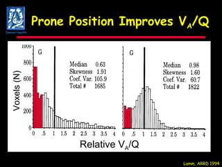 Prone Position Improves V A /Q Lamm, ARRD 1994 Relative V A /Q Voxels (N) Denver Health 