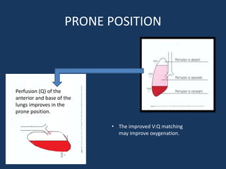 PRONE POSITION
Perfusion (Q) of the
anterior and base of the
lungs improves in the
prone position.
• The improved V:Q matching
may improve oxygenation.
 
