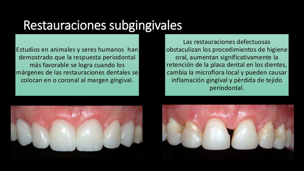 Pronostico y plan de tratamiento Periodontal