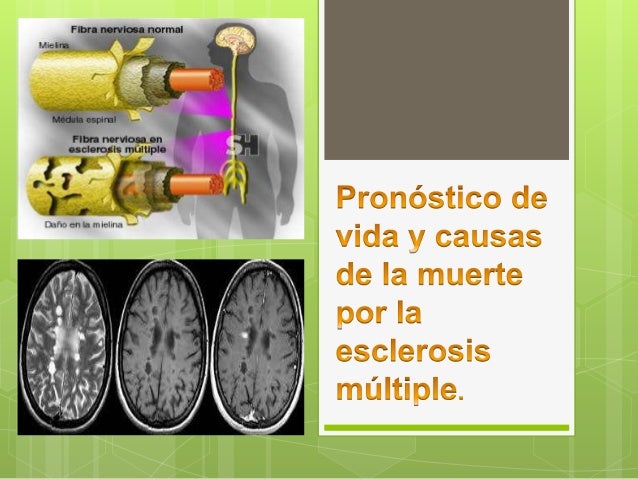 Pronostico De Vida Y Causas De La Muerte Por Esclerosis Multiple