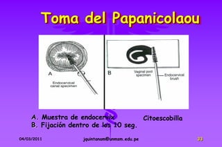 Toma del Papanicolaou




     A. Muestra de endocervix          Citoescobilla
     B. Fijación dentro de los 10 seg.
04/03/2011           jquintanam@unmsm.edu.pe           33
 
