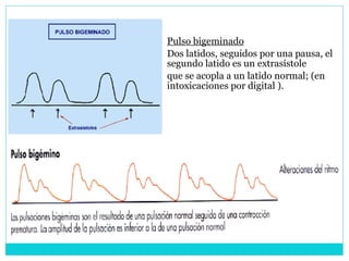 Pulso bigeminado Dos latidos, seguidos por una pausa, el segundo latido es un extrasístole que se acopla a un latido normal; (en intoxicaciones por digital ). 