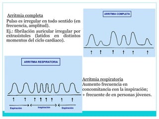 Arritmia completa Pulso es irregular en todo sentido (en frecuencia, amplitud).  Ej.: fibrilación auricular irregular por extrasístoles (latidos en distintos momentos del ciclo cardiaco). Arritmia respiratoria   Aumento frecuencia en concomitancia con la inspiración; + frecuente de en personas jóvenes.   