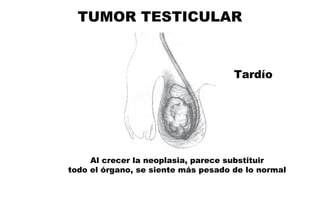 TUMOR TESTICULAR Al crecer la neoplasia, parece substituir todo el órgano, se siente más pesado de lo normal Tardío 