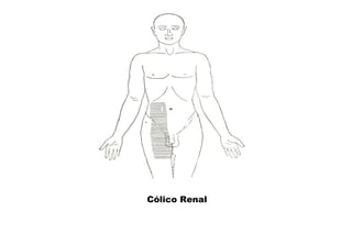 Cólico Renal 