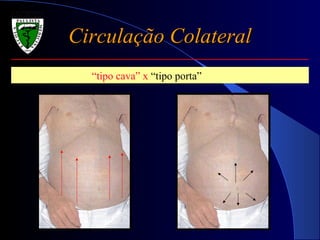 Circulação ColateralCirculação Colateral
“tipo cava” x “tipo porta”
 