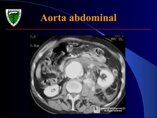 Aorta abdominalAorta abdominal
 