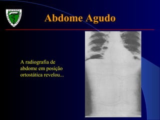 Abdome AgudoAbdome Agudo
A radiografia de
abdome em posição
ortostática revelou...
 