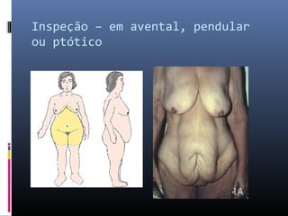 Inspeção – em avental, pendular 
ou ptótico 
 