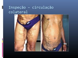 Inspeção – circulação 
colateral 
 
