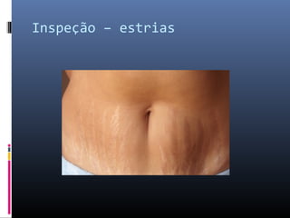 Inspeção – estrias 
 
