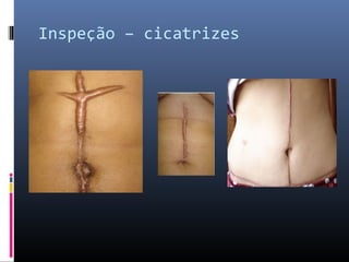 Inspeção – cicatrizes 
 