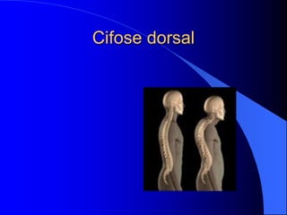 Cifose dorsal
 
