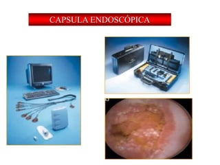 CAPSULA ENDOSCÓPICA
 