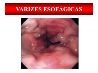 VARIZES ESOFÁGICAS
 