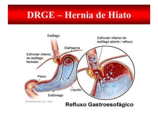 DRGE – Hernia de Hiato
 