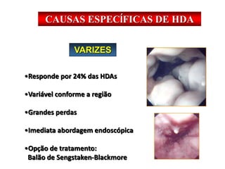 VARIZES
•Responde por 24% das HDAs
•Variável conforme a região
•Grandes perdas
•Imediata abordagem endoscópica
•Opção de tratamento:
Balão de Sengstaken-Blackmore
CAUSAS ESPECĺFICAS DE HDA
 
