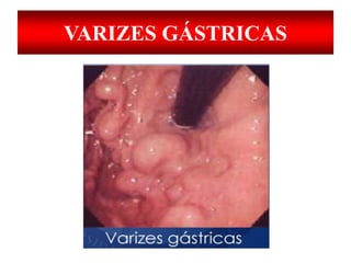 VARIZES GÁSTRICAS
 