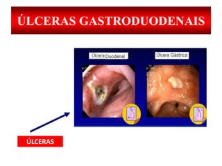 ÚLCERAS GASTRODUODENAIS
ÚLCERAS
 