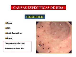 GASTRITES
Etanol
AAS
Antiinflamatórios
Stress
Sangramento discreto
Boa resposta aos IBPs
CAUSAS ESPECĺFICAS DE HDA
 