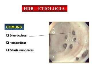 HDB – ETIOLOGIA
COMUNS
 Diverticulose
 Hemorróidas
 Ectasias vasculares
 