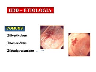 COMUNS
Diverticulose
Hemorróidas
Ectasias vasculares
HDB – ETIOLOGIA
 