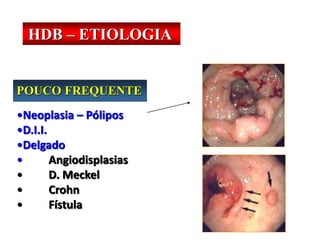 POUCO FREQUENTE
•Neoplasia – Pólipos
•D.I.I.
•Delgado
• Angiodisplasias
• D. Meckel
• Crohn
• Fístula
HDB – ETIOLOGIA
 
