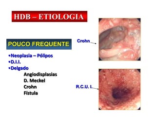POUCO FREQUENTE
•Neoplasia – Pólipos
•D.I.I.
•Delgado
Angiodisplasias
D. Meckel
Crohn
Fístula
Crohn
R.C.U. I.
HDB – ETIOLOGIA
 