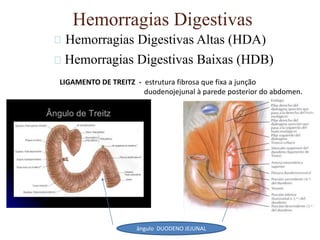 Hemorragias Digestivas
Hemorragias Digestivas Altas (HDA)
Hemorragias Digestivas Baixas (HDB)
LIGAMENTO DE TREITZ - estrutura fibrosa que fixa a junção
duodenojejunal à parede posterior do abdomen.
ângulo DUODENO JEJUNAL
 