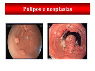 Pólipos e neoplasias
 