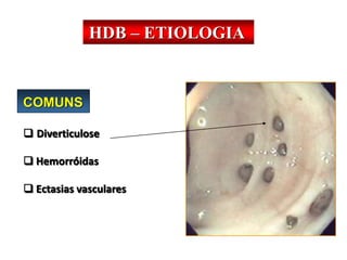 HDB – ETIOLOGIA
COMUNS
 Diverticulose
 Hemorróidas
 Ectasias vasculares
 