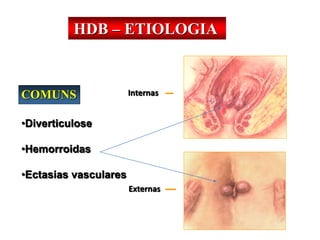 COMUNS
•Diverticulose
•Hemorroidas
•Ectasias vasculares
Internas
Externas
HDB – ETIOLOGIA
 