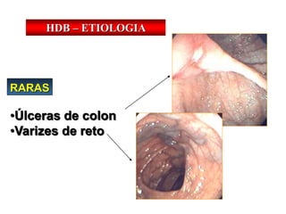 HDB – ETIOLOGIA
RARAS
•Úlceras de colon
•Varizes de reto
 