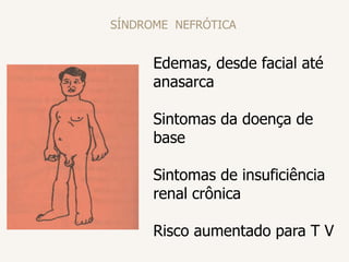 SÍNDROME NEFRÓTICA
Edemas, desde facial até
anasarca
Sintomas da doença de
base
Sintomas de insuficiência
renal crônica
Risco aumentado para T V
 