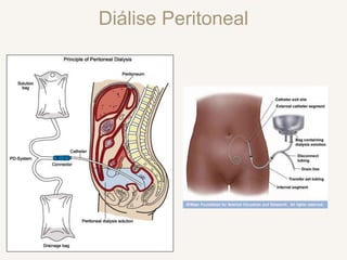 Diálise Peritoneal
 