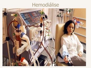 Hemodiálise
 