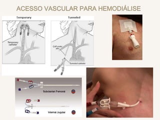ACESSO VASCULAR PARA HEMODIÁLISE
 