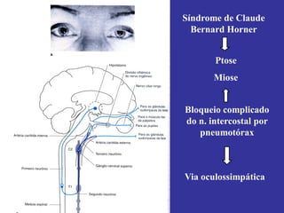 Síndrome de Claude
Bernard Horner
Ptose
Miose
Bloqueio complicado
do n. intercostal por
pneumotórax
Via oculossimpática
 