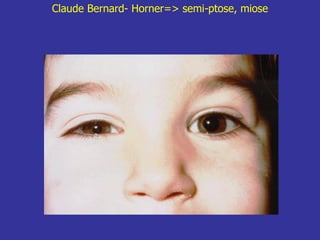 Claude Bernard- Horner=> semi-ptose, miose
 
