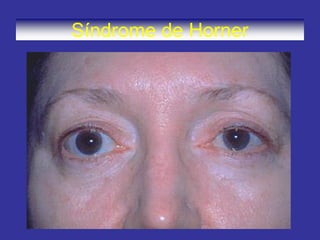 Síndrome de Horner
 
