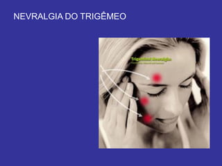 NEVRALGIA DO TRIGÊMEO
 