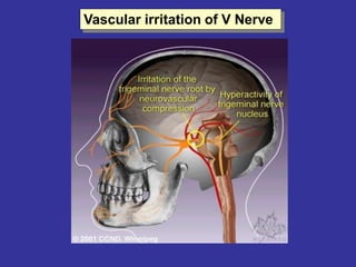 Vascular irritation of V Nerve
 