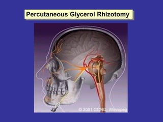 Percutaneous Glycerol Rhizotomy
 
