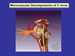 Microvascular Decompression of V nerve
 